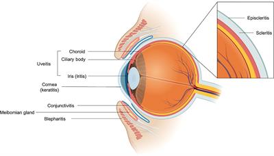 Case report: Immune-mediated meibomian gland dysfunction following pembrolizumab therapy for advanced urothelial carcinoma